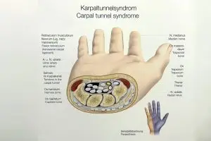 Carpaal tunnel syndroom